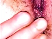 Perparazione anale